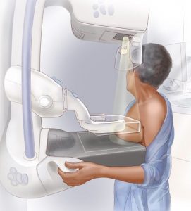 Mammography-e1491944088912-271x300