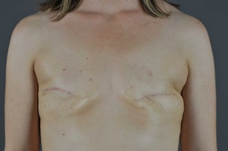 Breast-recon-pre-op