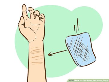 aid3825713-v4-728px-get-rid-of-self-harm-scars-step-1-version-3